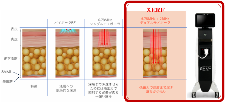 XERF（RF機器） たるみ、リフトアップ治療 - makiスキンケアクリニック